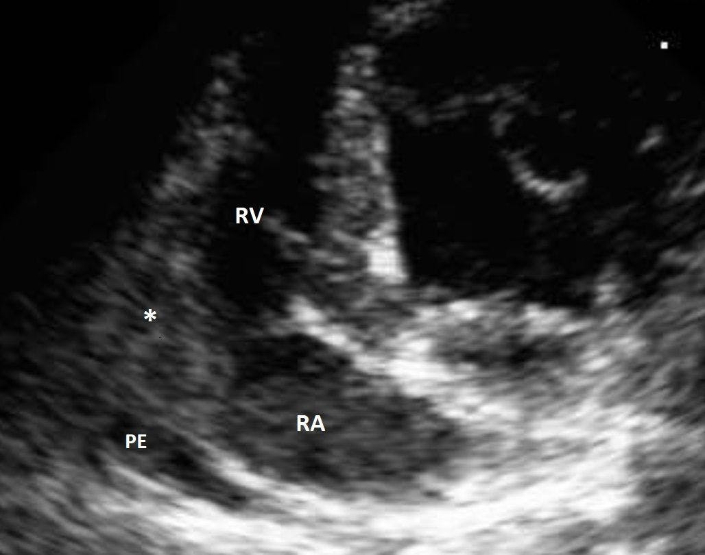 Figure 2. Left apical 4-chamber view with the right heart chambers depicted on the left side of the image, the right ventricle in the near field, and the right atrium in the deeper field. A roughly circular, well-defined hypoechoic mass (asterisk) can be seen in the junction between the right atrium and ventricle; the mass is heterogeneous due to multifocal hypoechoic areas. A moderate-volume pericardial effusion is visible as the anechoic area surrounding the heart. The echocardiographic diagnosis in this geriatric German shepherd dog was a right atrial mass; due to tumor location and patient signalment, the tentative diagnosis was hemangiosarcoma.