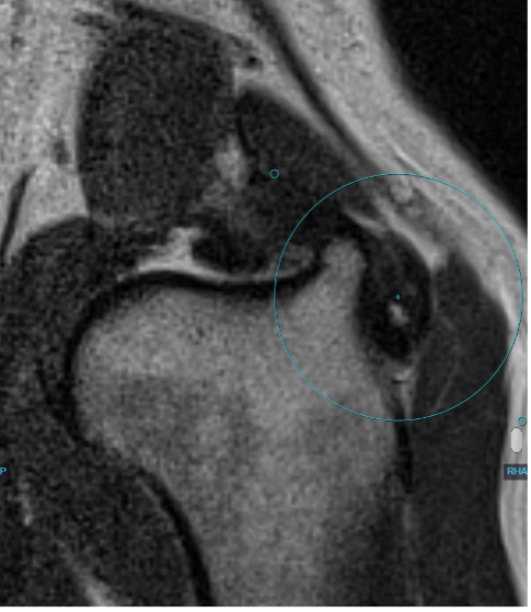 Figure 9. Thickened infraspinatus tendon with heterogeneous signal (large circle) on MRI. This finding was noted in a geriatric Labrador retriever with a chronic history of bilateral forelimb lameness.