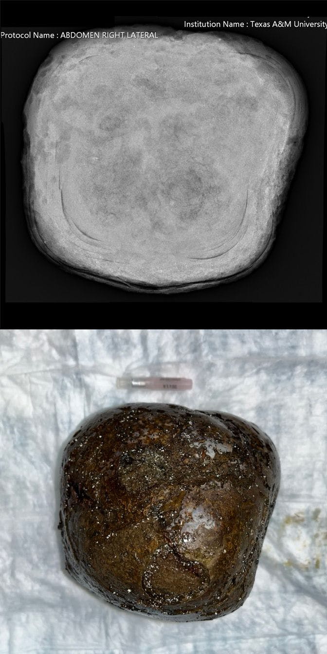 The X-ray of the cantaloupe-sized stone found in Koche’s colon and the stone next to a one-inch needle 